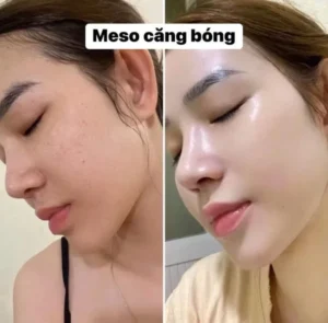 tiem-meso-co-hai-khong-tac-hai-bien-chung