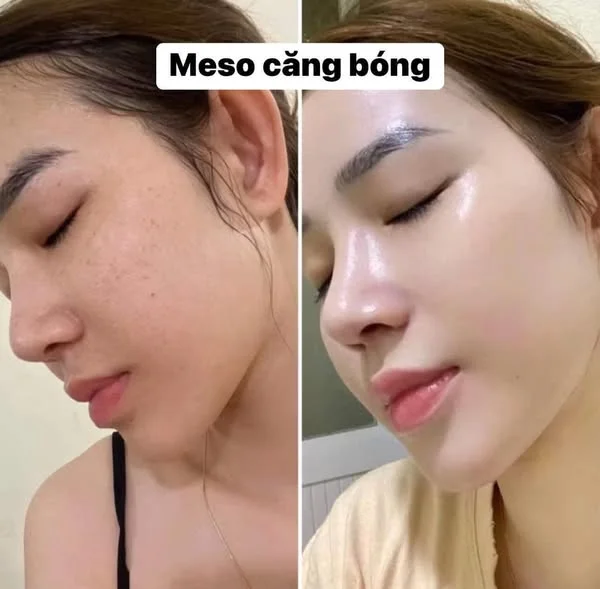 tiem-meso-co-hai-khong-tac-hai-bien-chung